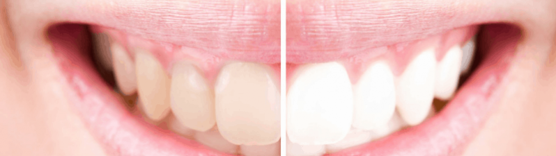 Help, my teeth are changing colour! What to do if certain foods stain your teeth