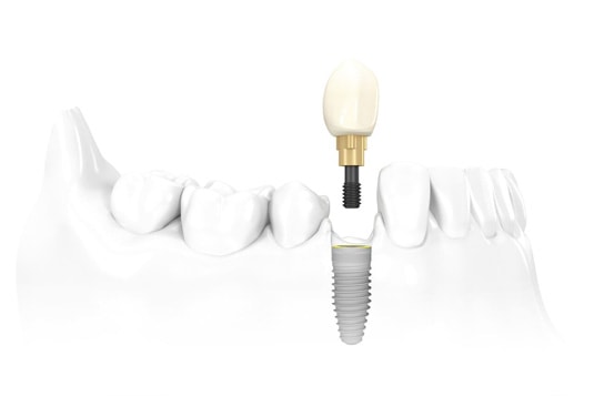 Benowa Dental Implants