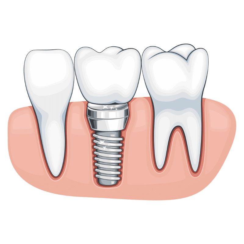 dental-implants-define-dental | Define Dental Illustration of a dental implant replacing a missing tooth with a crown attached to an abutment in the gum line