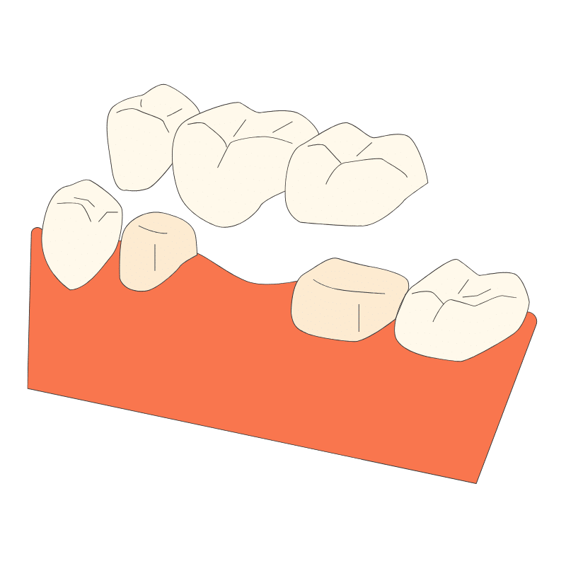 Illustration of a dental model showing a row of teeth mounted on an orange gum-like base, viewed from the side/angle