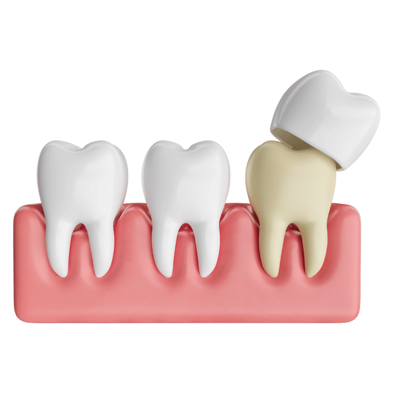 dentist-gold-coast-dental-crowns | Define Dental Dental model showing three molars on pink gums with a crown being placed on the rightmost tooth.