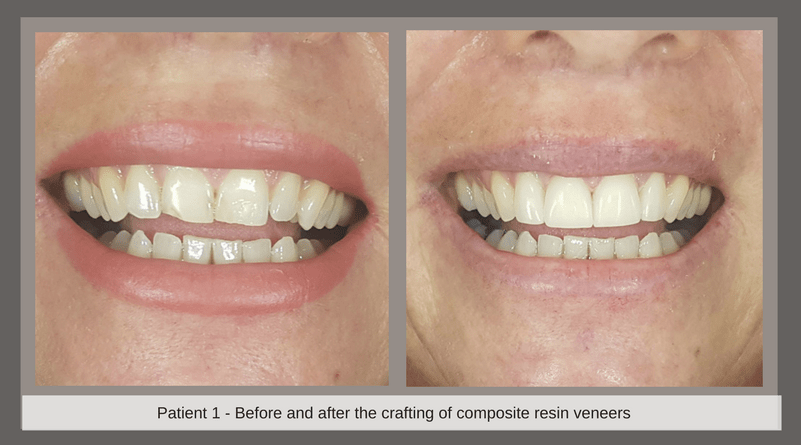 gold coast dental veneers