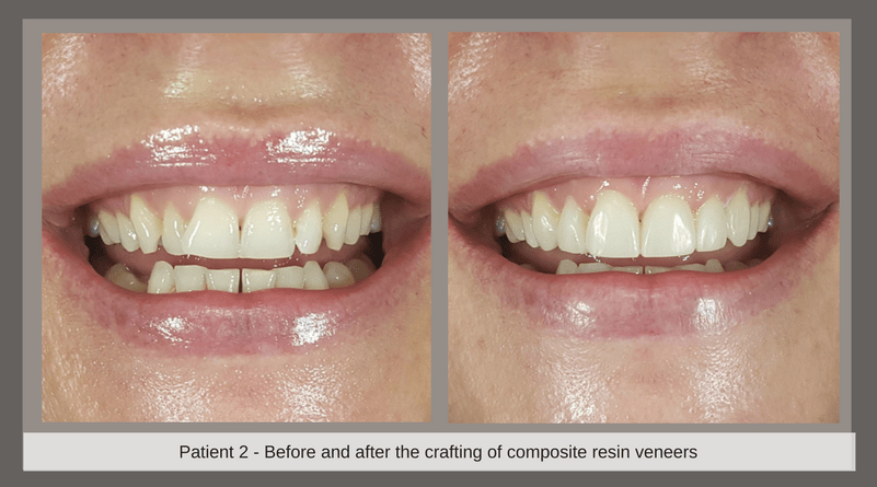 gold coast dental veneers