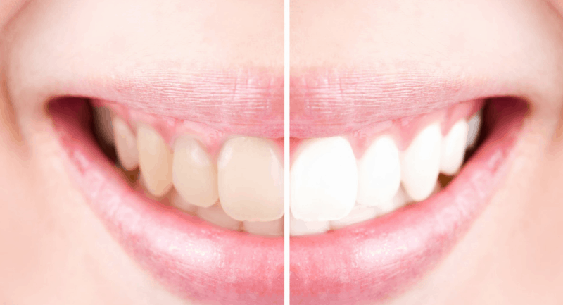 Help, my teeth are changing colour! What to do if certain foods stain your teeth