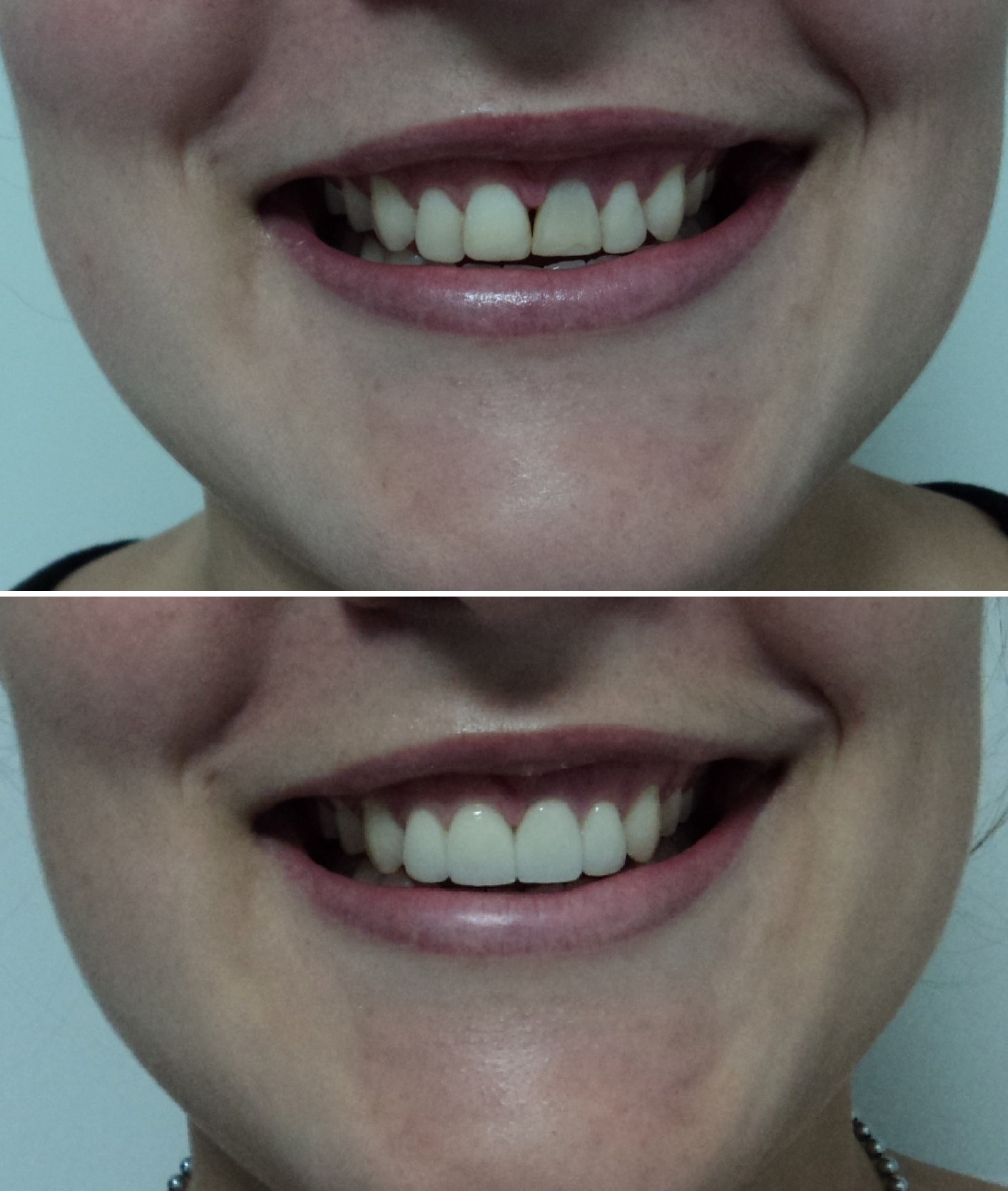 Teeth Repair