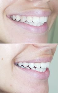 Teeth Repair