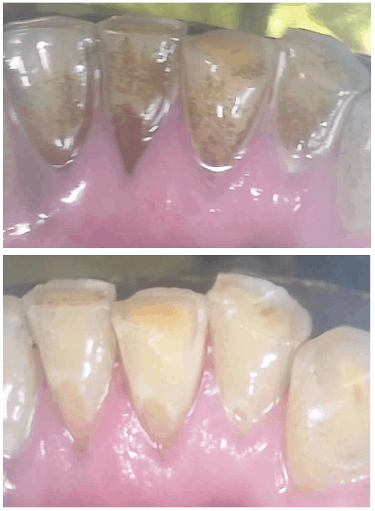 Teeth Repair