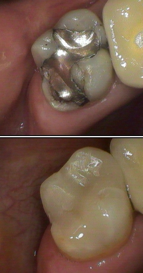 Teeth Repair