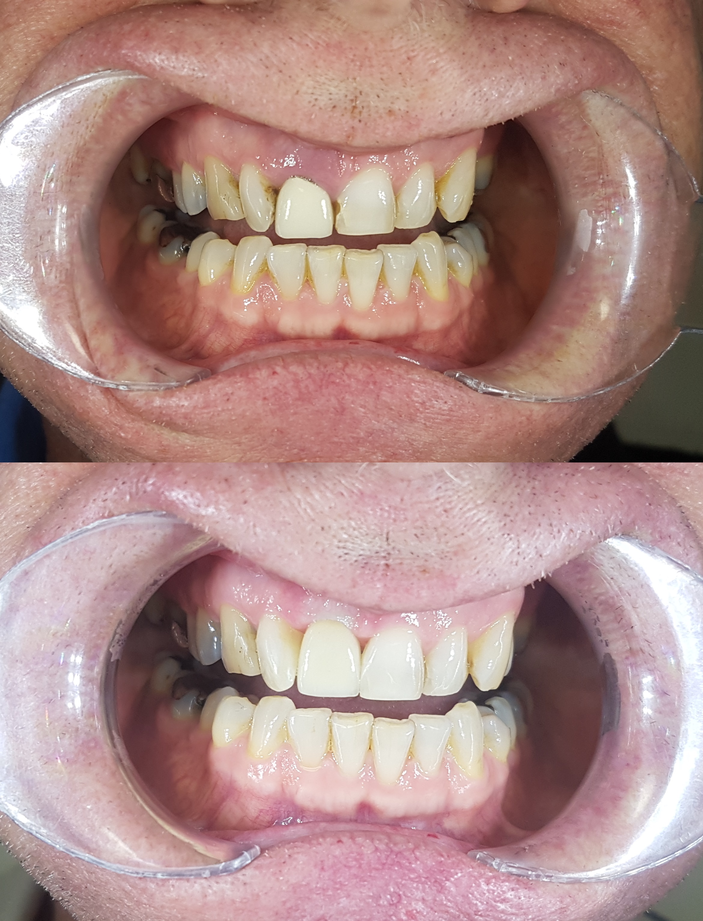 Teeth repair