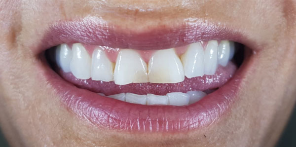 Porcelain Veneers | Define Dental | Define Dental Porcelain Veneers