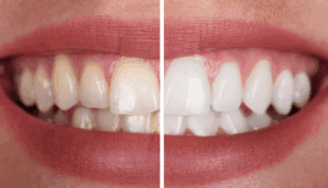 Benowa Teeth Whitening  | Define Dental | Define Dental Benowa Teeth Whitening