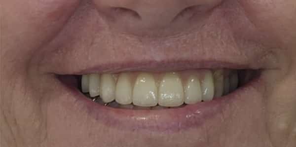 PPB&A 3&4 with border | Define Dental PPB&A 3&4 with border