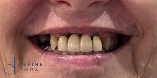 PPB&A 3&4 with border | Define Dental PPB&A 3&4 with border