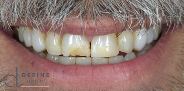 PPB&A 3&4 with border | Define Dental PPB&A 3&4 with border