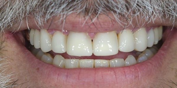 PPB&A 3&4 with border | Define Dental PPB&A 3&4 with border