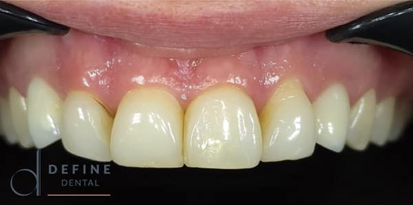 PPB&A 3&4 with border | Define Dental PPB&A 3&4 with border