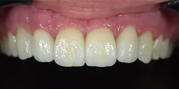 PPB&A 3&4 with border | Define Dental PPB&A 3&4 with border