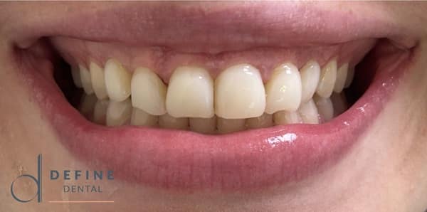 PPB&A 3&4 with border | Define Dental PPB&A 3&4 with border