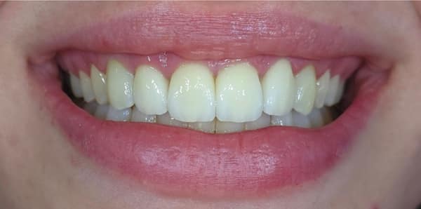 PPB&A 3&4 with border | Define Dental PPB&A 3&4 with border