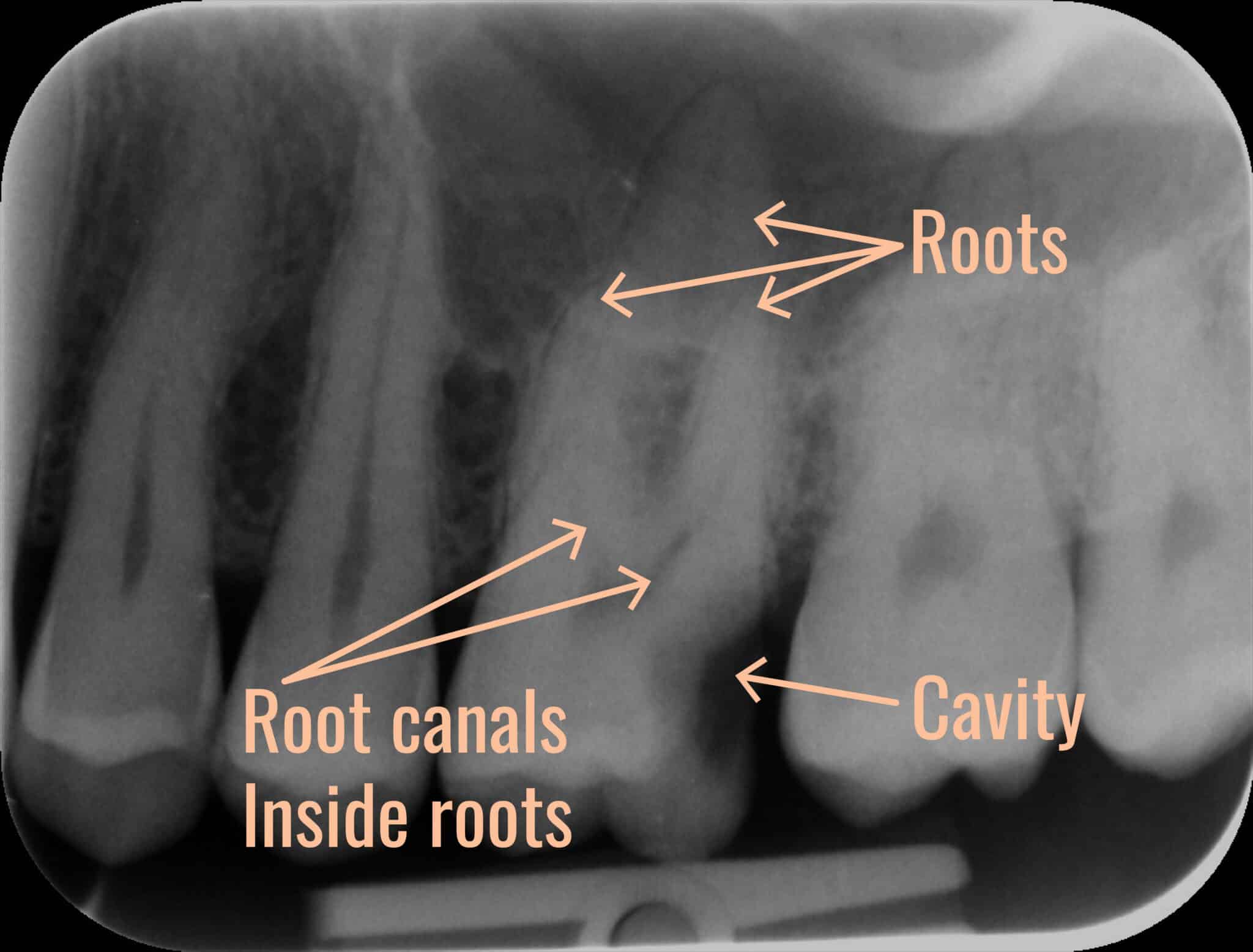Dental X-ray showing a tooth with root canals and a cavity labeled as internal structures.